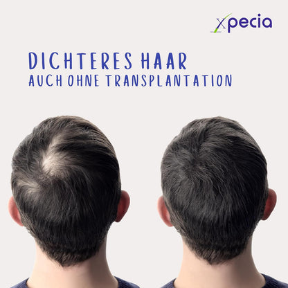 Xpecia DHT Blocker mit Biotin und Sägepalmextrakt - Gegen Haarausfall Männer - Ginko Wurzel, Haar Vitamine, Sägepalme - Haarwachstum beschleunigen - Nachbehandlung Haartransplantationen