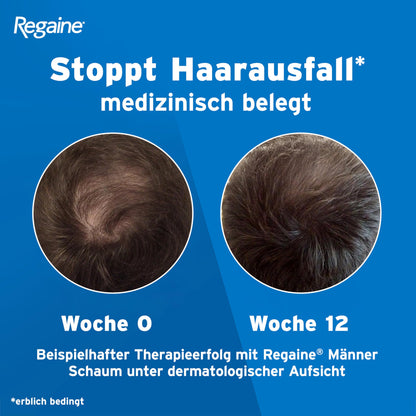 REGAINE Männer Lösung: Mit 50 mg/ml Minoxidil (5%) bei erblich bedingtem Haarausfall, 3-Monatspackung, 3 x 60 ml